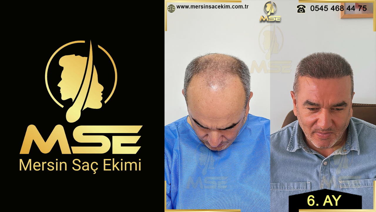 MERSİN SAÇ EKİMİ